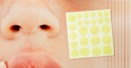 Acne Patches: Battle of the Drugstore and Other Acne Solutions