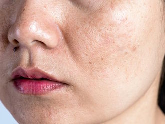 Beauty Diagnosis: Is Your Skin Dry or Dehydrated?